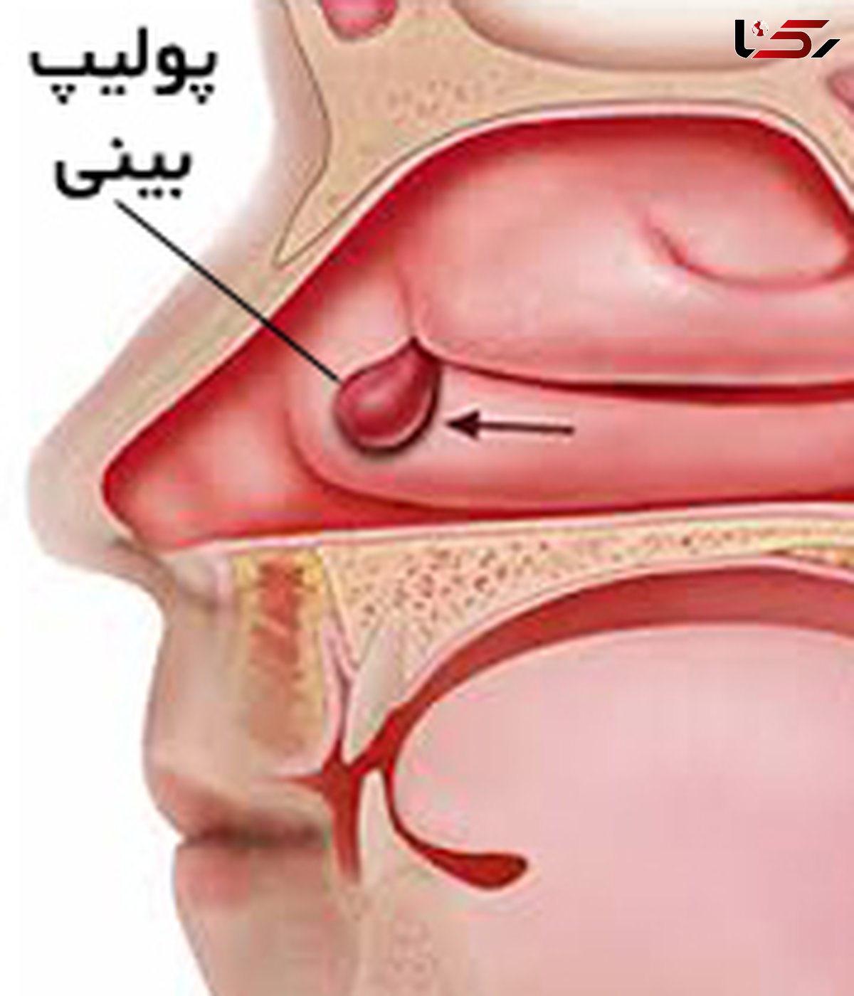 درمان های پولیپ بینی