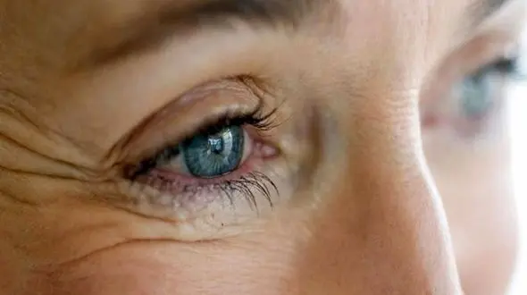  40 درصد از مردم ایران به پیر چشمی مبتلا هستند / کاهش کیفیت زندگی و سردرد نتیجه پیر چشمی است